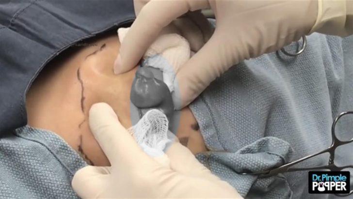 Kalçasından çıkanlar şoke etti  G5