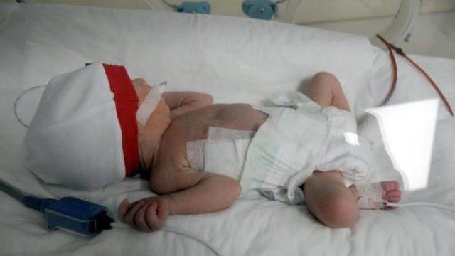 Bir Günlük Bebeğe Yemek Borusu Ameliyatı