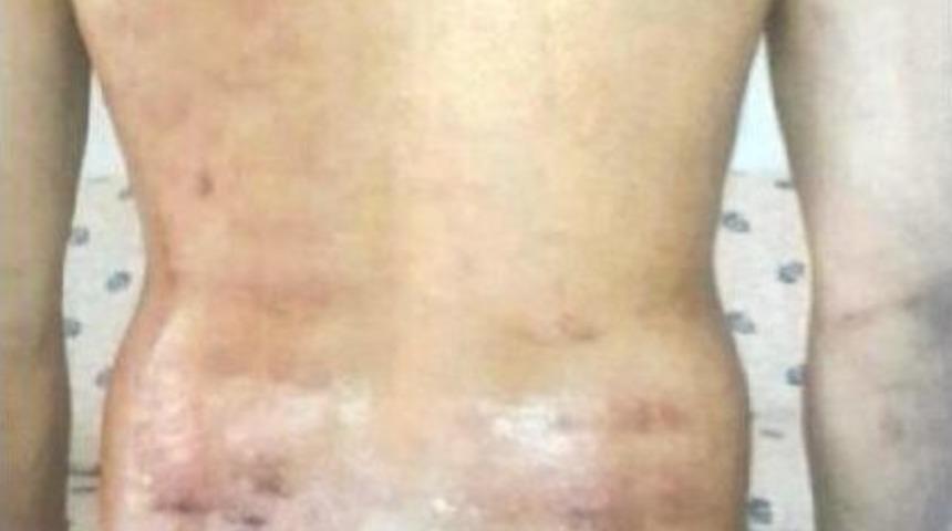 V&uuml;cudu Y&uuml;zde 18 Yakan Epilasyona 1500 Lira Ceza