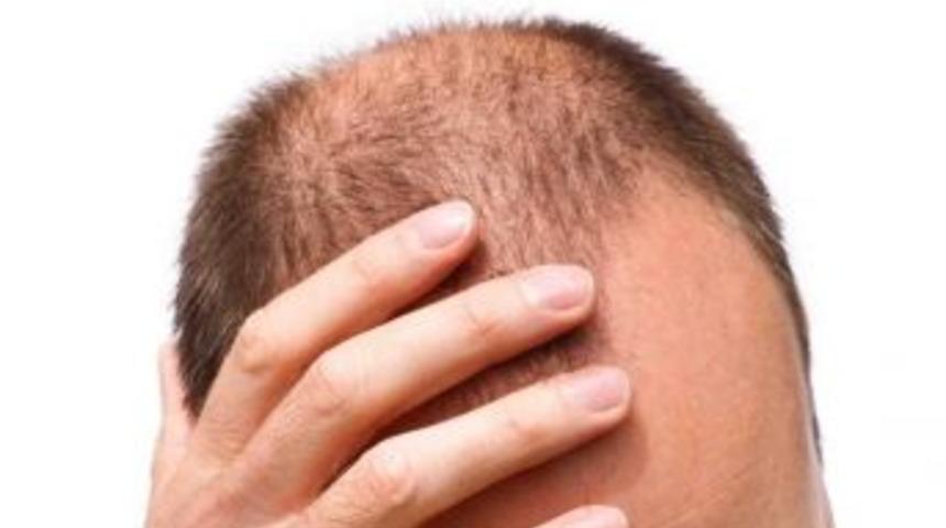 Sa&ccedil; D&ouml;k&uuml;lmesi Hakkında Doğru Bilinen Yanlışlar