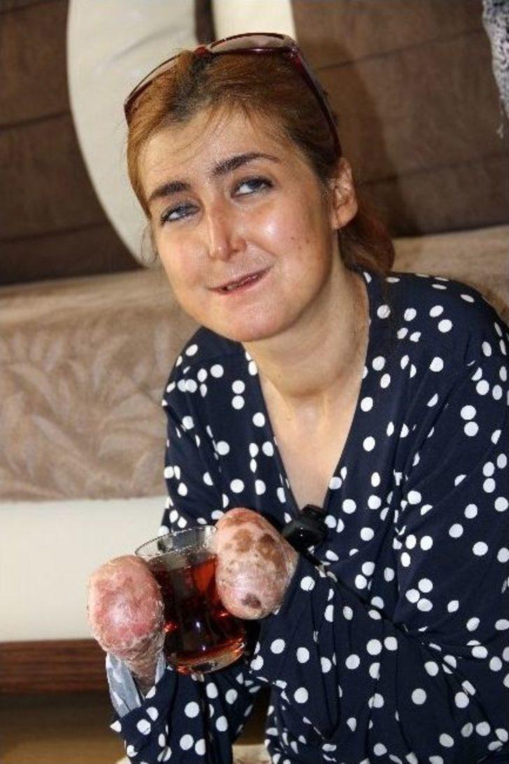 Milyonda bir görülen hastalık onu buldu Milyonda bir görülen hastalık onu buldu