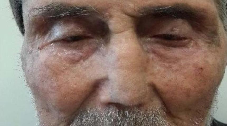 Yaşlı Hastaya Alnından Alınan Dokuyla Burun Yapıldı