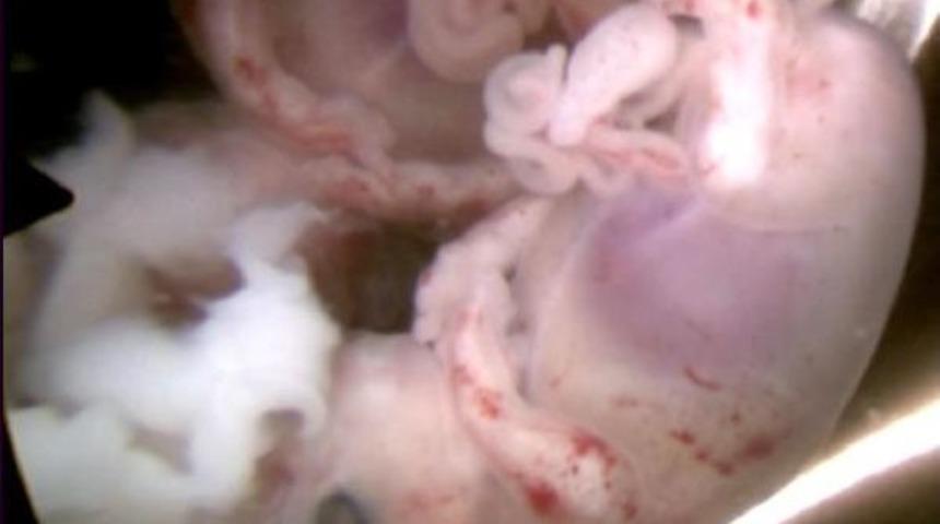 Bebeğin Kalbi Ve Organları Dışarıda Olunca Hamilelik Sonlandırıldı