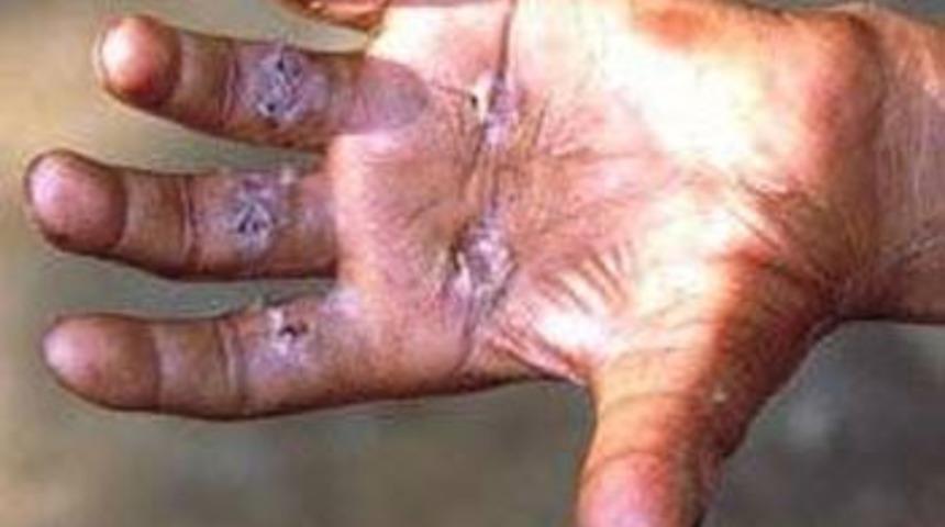  LEPRA HASTALIĞI NEDİR?