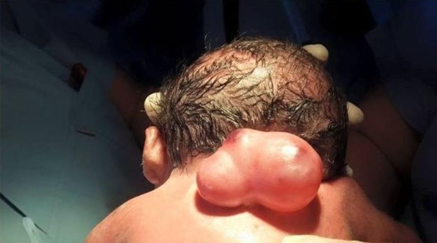 Omuriliği Dışarıda Doğan Bebek, Doğumundan 8 Saat Sonra Ameliyat Edildi