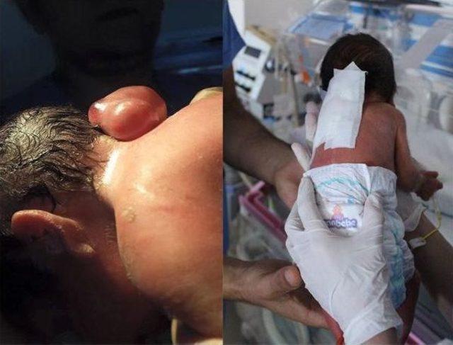 Omurilik Kesesi Açıkta Doğan Bebek Ameliyatla Sağlığına Kavuştu