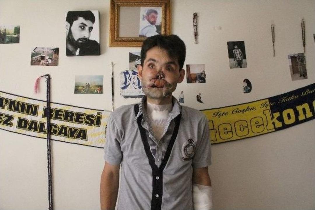 (&ouml;zel Haber) Y&uuml;z&uuml;nde T&uuml;fek Fişeği Patlayan Ahmet İlk Ameliyatını Oldu