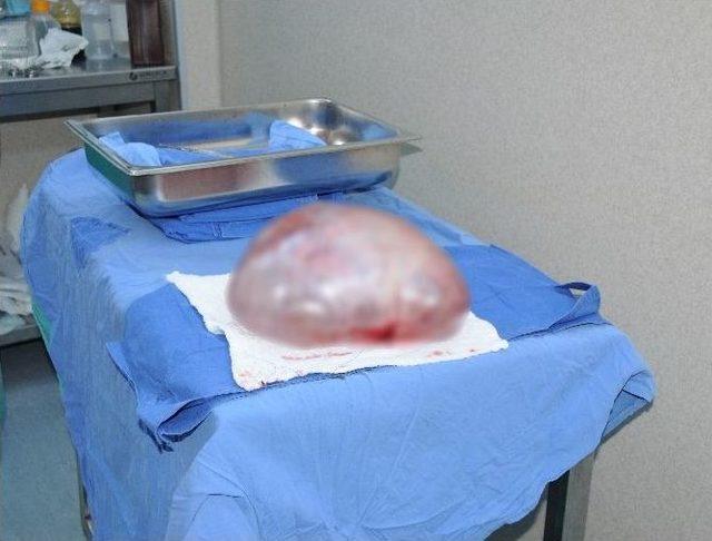 Fıtık Şikayetiyle Gitti, Karnından 11 Kiloluk Kist &Ccedil;ıktı 1