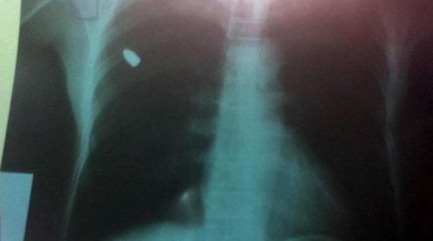 G&ouml;ğs&uuml;ne Isabet Eden Kurşunu Taş Zannetti