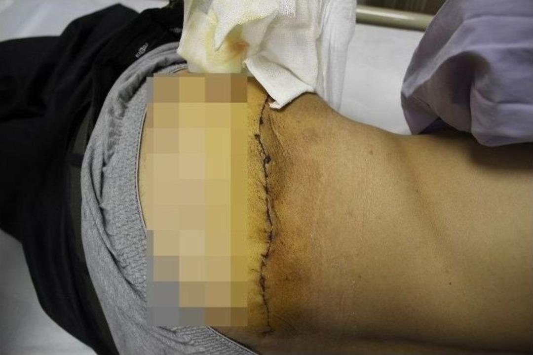 (&ouml;zel Haber) T&uuml;m&ouml;r Nedeniyle 6 Yıl Boyunca Uyuyamadı