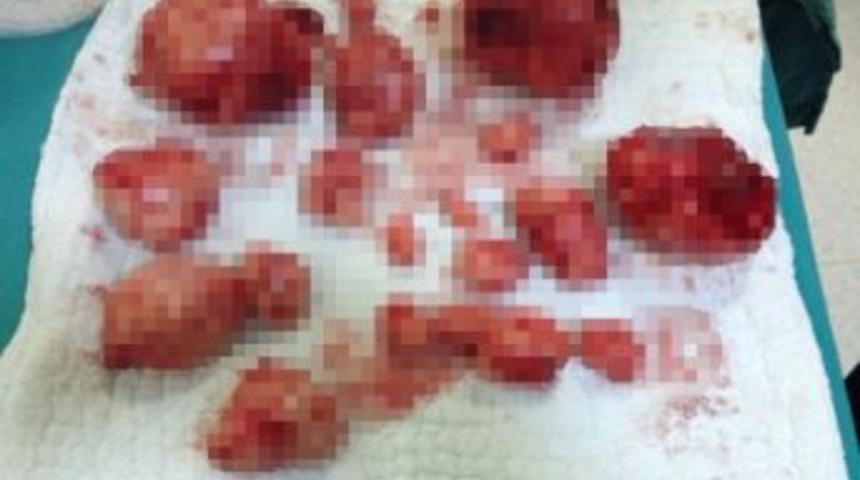 Karın Ağrısıyla Gitti, Rahminden 31 Miyom Tümörü Çıkarıldı