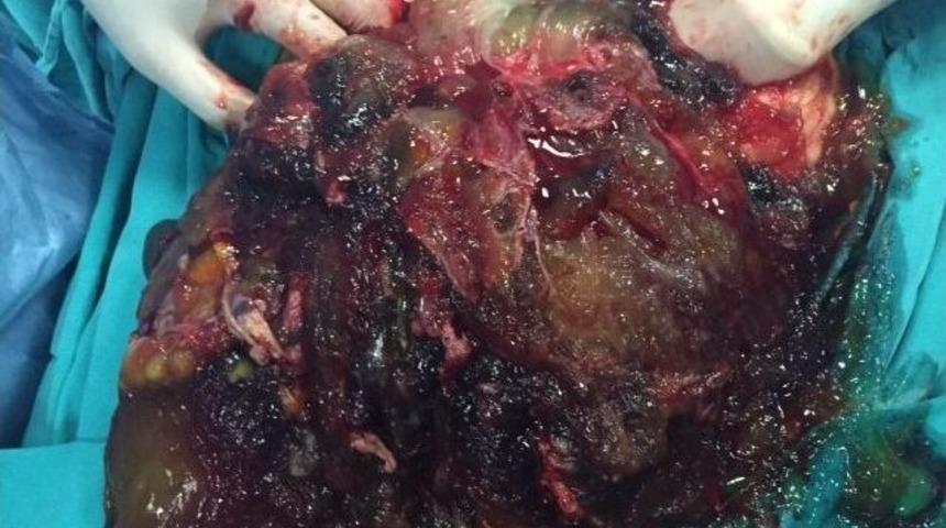 Karın Şişliği Diye Gitti, 5 Kilogram T&uuml;m&ouml;r &Ccedil;ıktı