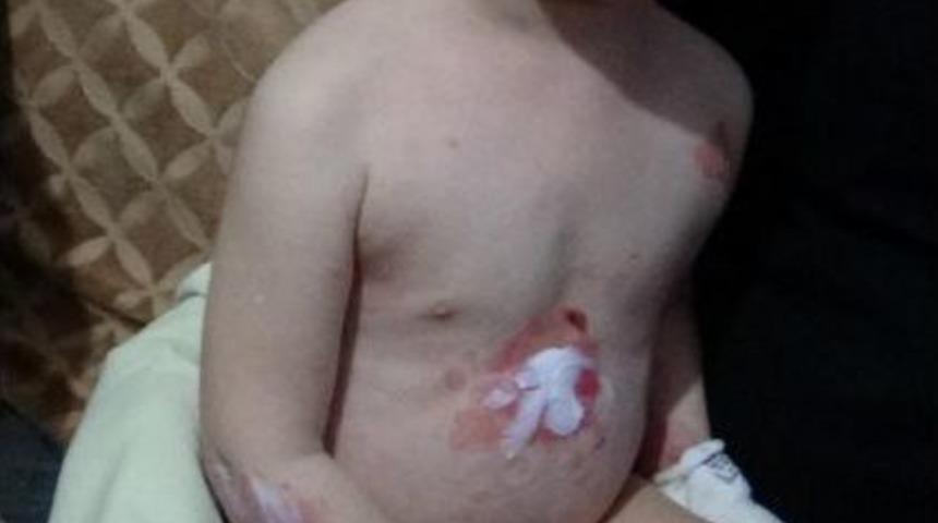 El Ve Ayakları Eriyor