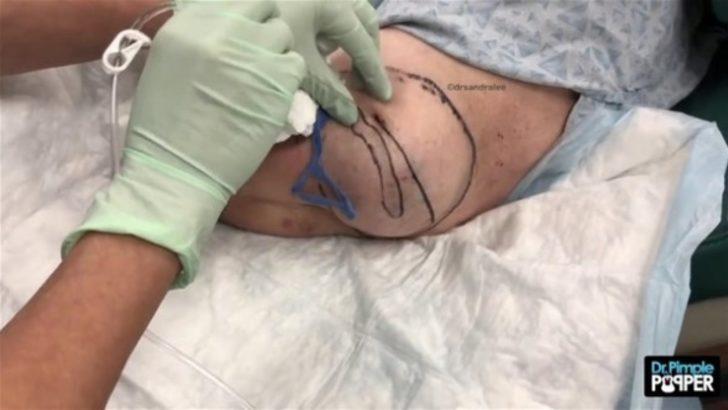 Koca kisti böyle çıkardı! G3