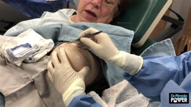 Koca kisti böyle çıkardı! G5