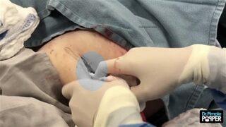 Koca kisti böyle çıkardı!