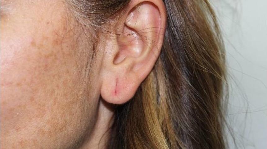 K&uuml;&ccedil;&uuml;k Yaştaki Kız &Ccedil;ocuklarına Takılan K&uuml;pe, Kulak Memesini Yırtabilir