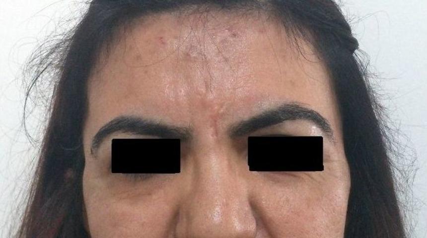 Yağ Dolgusu İle Alın B&ouml;lgesindeki &Ccedil;&ouml;k&uuml;kl&uuml;k D&uuml;zeltildi