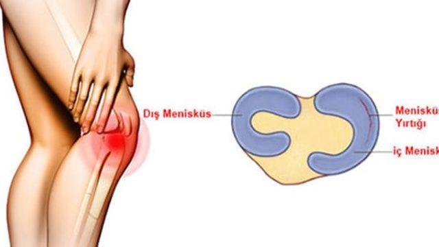 Diz menisküs yırtığı nedir? Diz menisküs yırtığı belirtileri nelerdir? Diz menisküs yırtığı tedavisi nasıl olur?