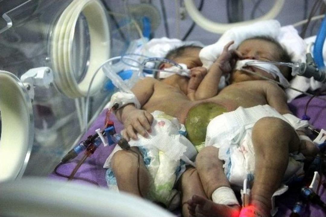 M&uuml;lteci Ailenin Siyam İkizi D&uuml;nyaya Geldi