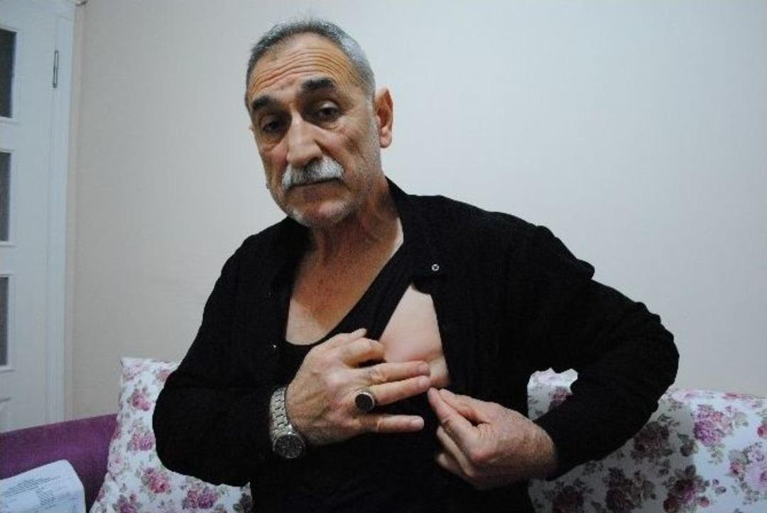 Kalbinin &Uuml;st&uuml;ne Saplanan Keneyle Bir Yıl Yaşadı