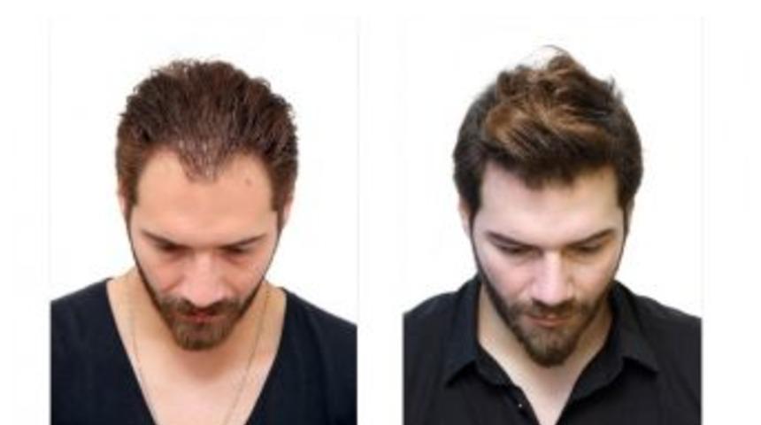 Depresyondaki Sa&ccedil;lara Organik &Ccedil;&ouml;z&uuml;m