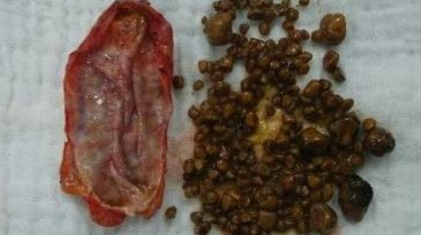 Safra Kesesinden 305 Tane Taş &Ccedil;ıktı