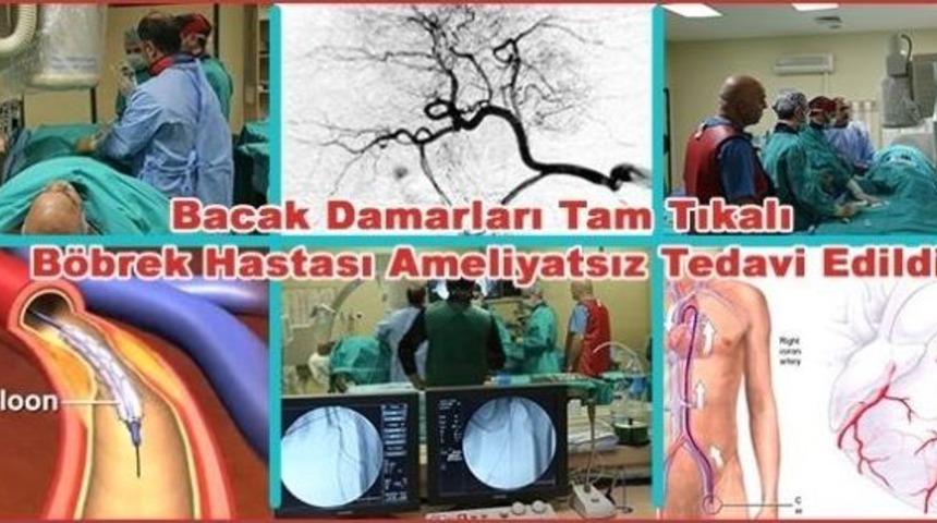 Diyaliz Hastasının Tıkalı Olan Bacağı Ameliyatsız Y&ouml;ntemle Kesilmekten Kurtuldu