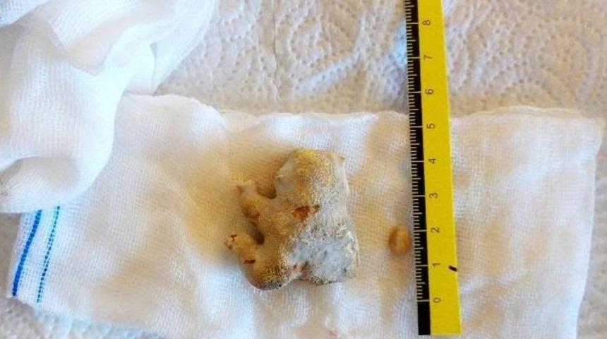 B&ouml;breğinden 4 Bu&ccedil;uk Santimetrelik Taş &Ccedil;ıkartıldı