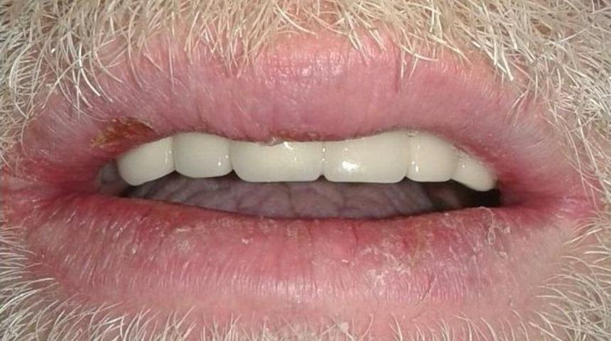 Dişleri Tamamen &Ccedil;&uuml;r&uuml;yen Hastaya Yeni Dişler Yapıldı