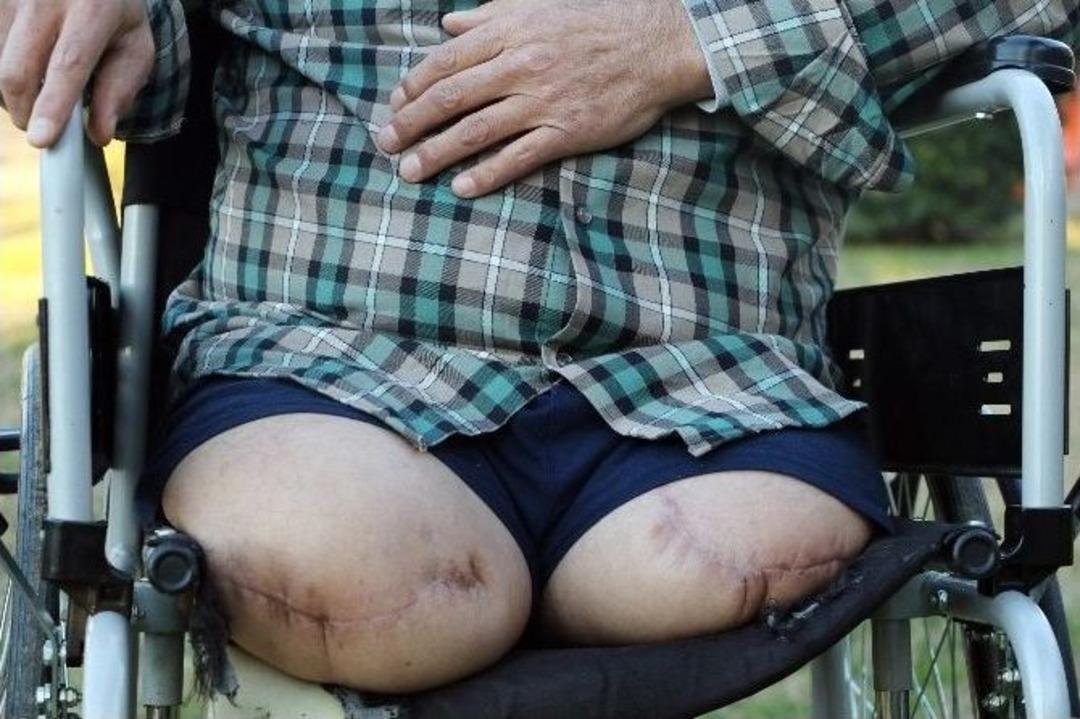 İki Bacağı Diz Altından Kesilen Şahıs Malulen Emeklilik İstiyor