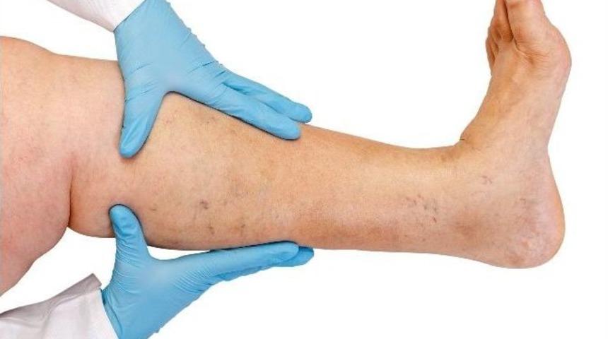 Varislerinizden Acısız Ve Ameliyatsız Kurtulun