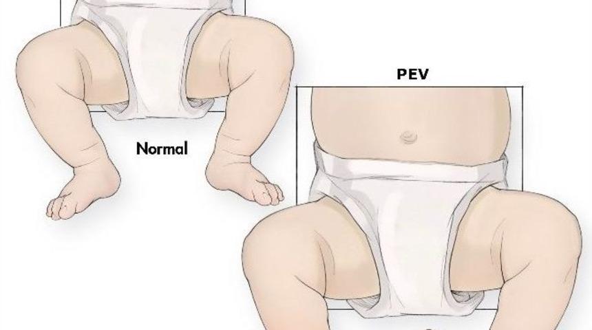 Doğuştan &Ccedil;arpık Ayak Uyarısı