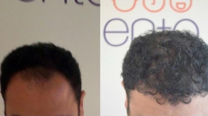 Sa&ccedil; Ekimi Operasyonlarında Şapka Uyarısı