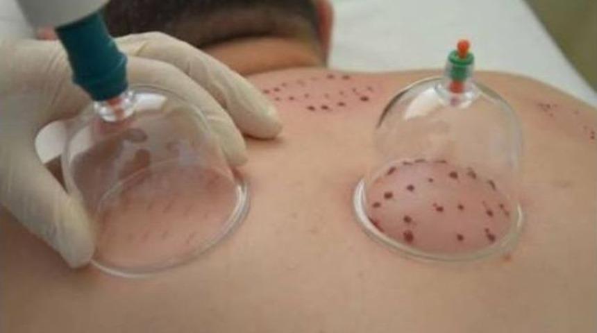 Hacamat Artık Hastanelerde Uygulanıyor