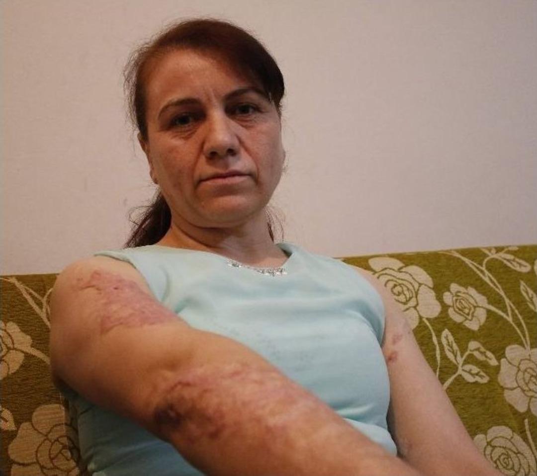 Kocasının Kızgın Yağ D&ouml;kerek Yaktığı Kadının Hayata Yeniden D&ouml;n&uuml;ş Hikayesi