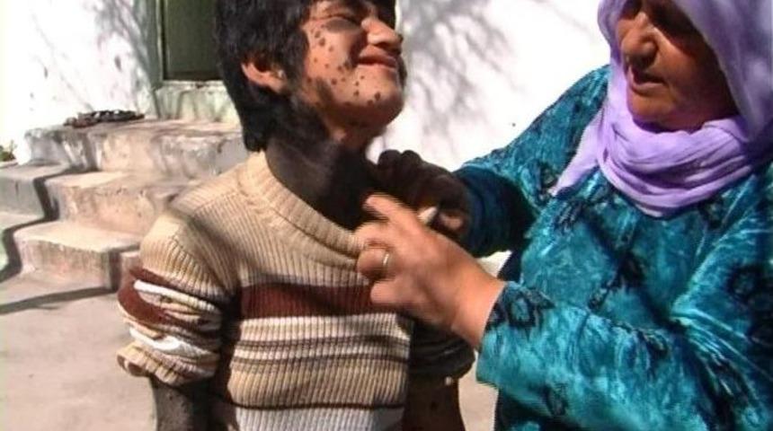 10 Yaşındaki Suriyeli Kızın Dramı Y&uuml;rek Burkuyor