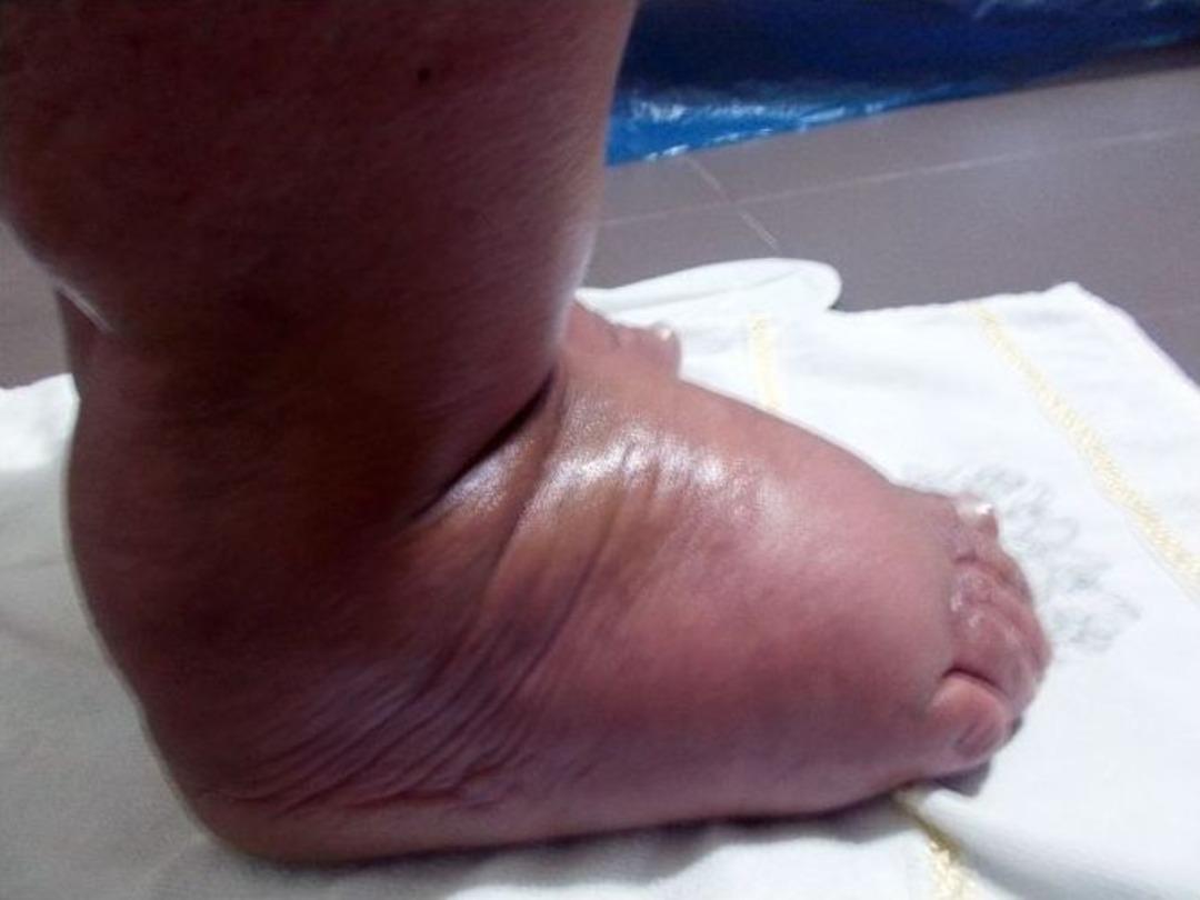 (&ouml;zel) 31 Yıl Sonra Fil Hastalığını Yendi İlk Kez Ayakkabı Giydi