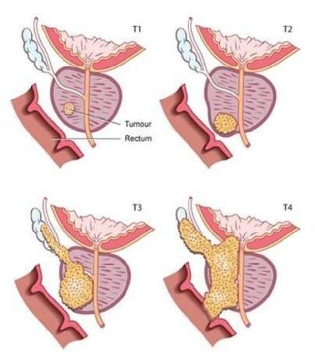 Prostat Kanserinde Erken Teşhisin Önemi