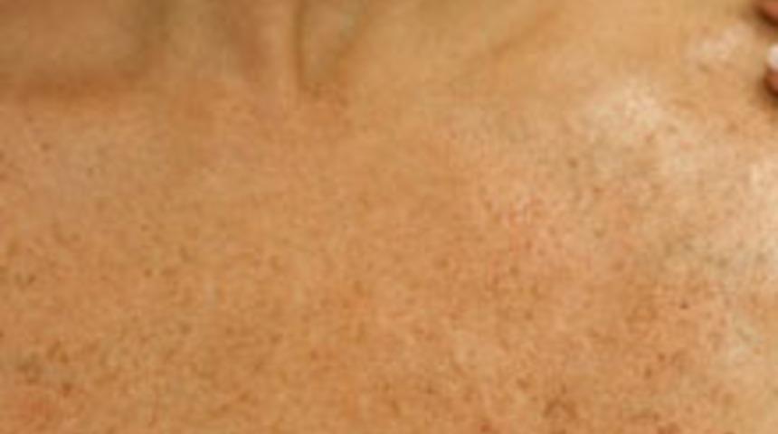 Lekelerden Karbon Tedavisiyle Kurtulun