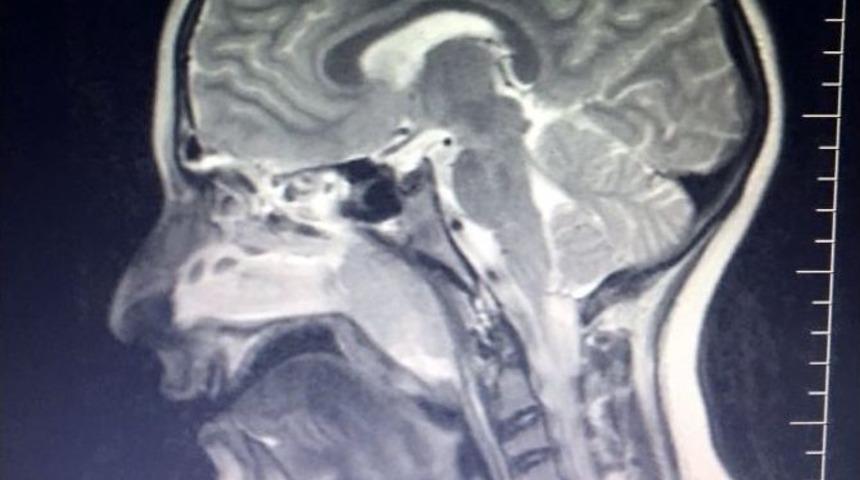 Geniz Eti &Ccedil;ocuklarda Uyku Ve Solunum Zorluğuna Yol A&ccedil;ıyor