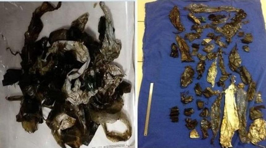 Midesinden 52 Naylon Poşet Par&ccedil;ası &Ccedil;ıkarıldı