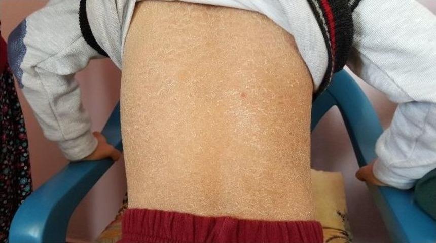 (&ouml;zel Haber) Yılan Derili &Ccedil;ocuklara Teşhis Konulamıyor