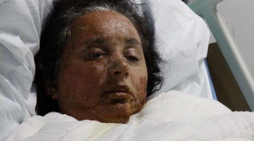 (&ouml;zel Haber) 20 Yıllık Eşini Uykusunda Kaynar Suyla Yaktı