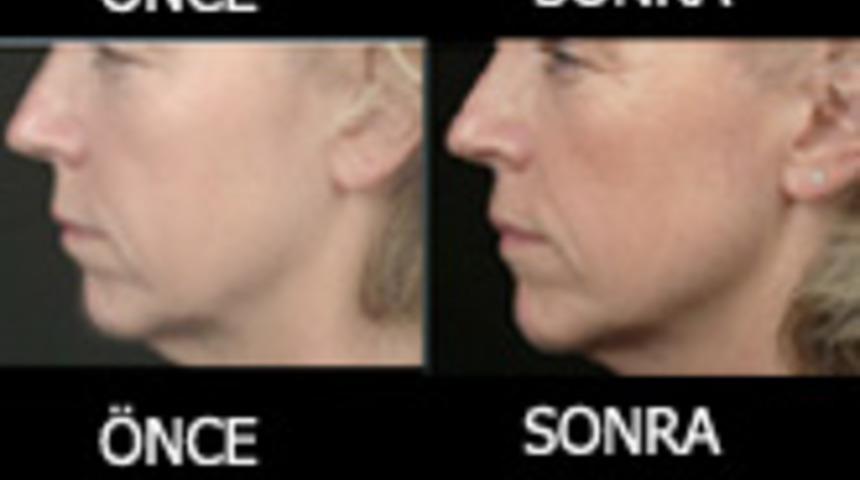 Y&uuml;z&uuml;n&uuml;z 30 Dakikada Gen&ccedil;leşiyor