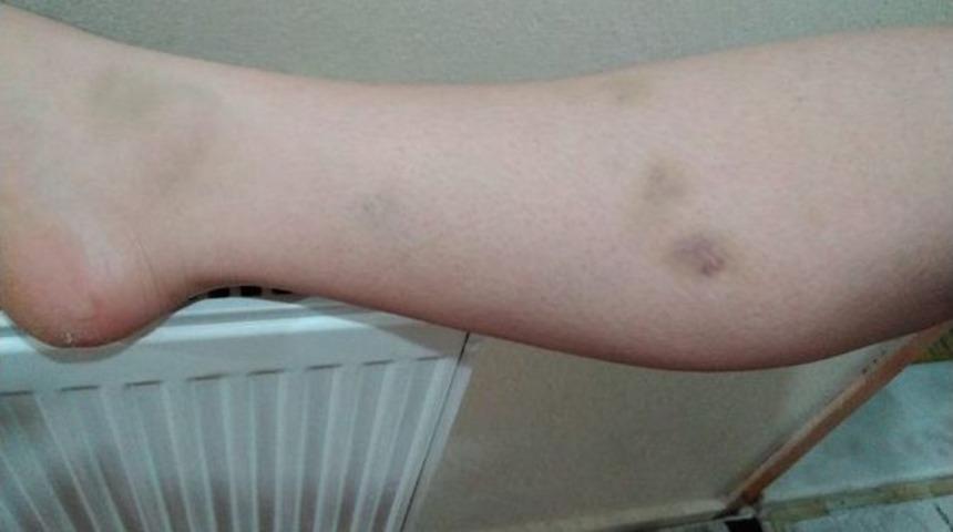 Darp Fotoğrafını Paylaştıktan Sonra İntihar Etti