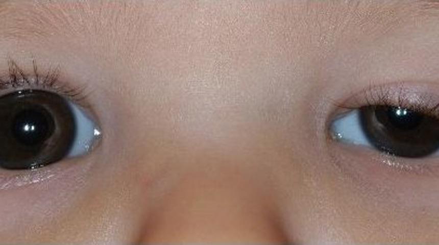 G&ouml;z Kapağı D&uuml;ş&uuml;kl&uuml;ğ&uuml;&rsquo;ne Dikkat