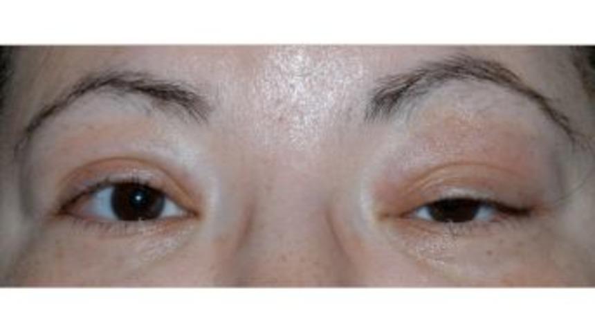 G&ouml;z Kapağı D&uuml;ş&uuml;kl&uuml;ğ&uuml; G&ouml;rme Kaybına Neden Olabiliyor