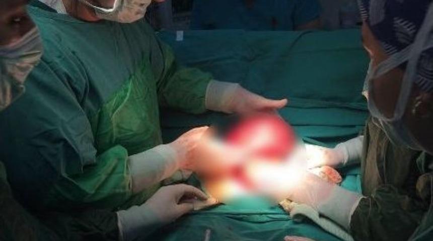 Rahminden 6,5 Kiloluk Kitle &Ccedil;ıkarıldı