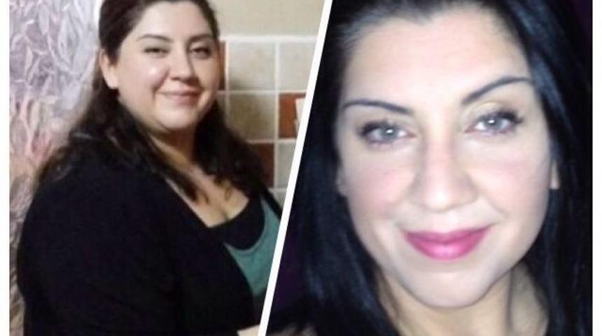 Obezitede Kalıcı Tedavinin Y&ouml;ntemi Gastrikby-pass